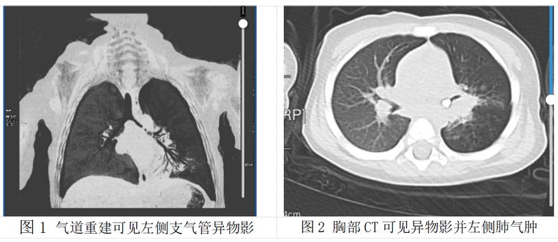 1岁宝宝误呛乳牙,反复肺炎50天!春节气道异物防护指南,家长必看 新闻
