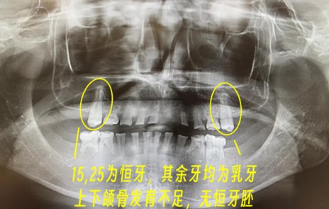  【技术解码】从“乳牙撑岗”到咬合重建：15岁少年口腔修复的全流程技术复盘 健康养生