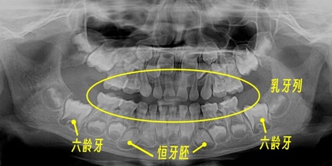  【技术解码】从“乳牙撑岗”到咬合重建：15岁少年口腔修复的全流程技术复盘 健康养生