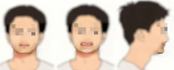  【技术解码】从“乳牙撑岗”到咬合重建：15岁少年口腔修复的全流程技术复盘 健康养生