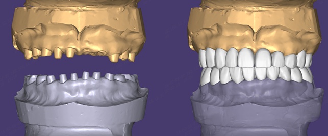  【技术解码】从“乳牙撑岗”到咬合重建：15岁少年口腔修复的全流程技术复盘 健康养生