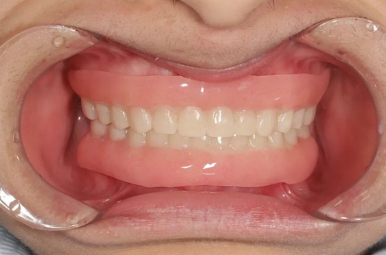  【技术解码】从“乳牙撑岗”到咬合重建：15岁少年口腔修复的全流程技术复盘 健康养生