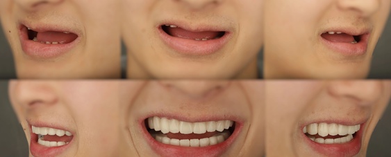  【技术解码】从“乳牙撑岗”到咬合重建：15岁少年口腔修复的全流程技术复盘 健康养生